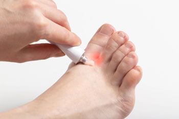 Athletes foot treatment in the Toronto, Scarborough, Markham, Richmond Hill, Oshawa, Vaughan, Brampton, Mississauga, Oakville Ontario areas