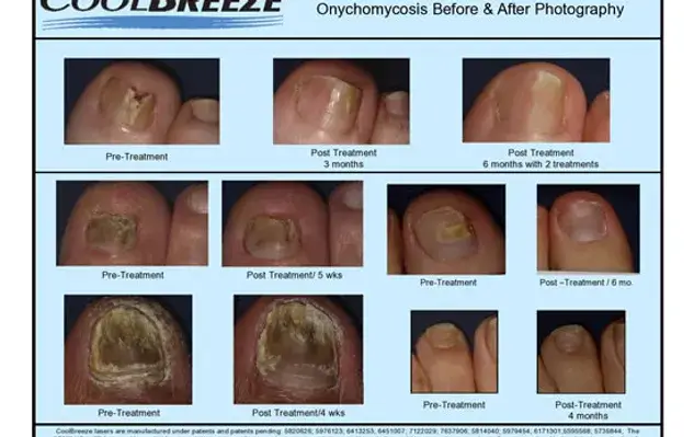 SCoolbreeze laser for toenail fungus Scarborough, ON Coolbreeze laser for toenail fungus in the Toronto, Scarborough, Markham, Richmond Hill, Oshawa, Vaughan, Brampton, Mississauga, Oakville Ontario areas