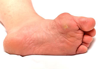 Corns treatment and removal in the Toronto, Scarborough, Markham, Richmond Hill, Oshawa, Vaughan, Brampton, Mississauga, Oakville Ontario areas