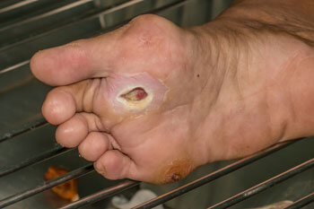 Diabetic foot care in the Toronto, Scarborough, Markham, Richmond Hill, Oshawa, Vaughan, Brampton, Mississauga, Oakville Ontario areas