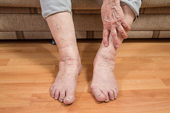 Elderly foot care, Geriatric foot care treatment in the Toronto, Scarborough, Markham, Richmond Hill, Oshawa, Vaughan, Brampton, Mississauga, Oakville Ontario areas