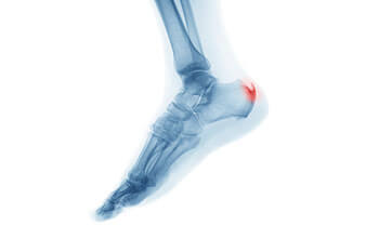 Heel spurs specialist in the Toronto, Scarborough, Markham, Richmond Hill, Oshawa, Vaughan, Brampton, Mississauga, Oakville Ontario areas