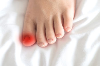 ingrown toenail treatment in the Toronto, Scarborough, Markham, Richmond Hill, Oshawa, Vaughan, Brampton, Mississauga, Oakville Ontario areas