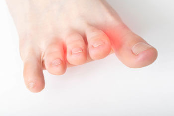 Mortons' neuroma specialist in the Toronto, Scarborough, Markham, Richmond Hill, Oshawa, Vaughan, Brampton, Mississauga, Oakville Ontario areas