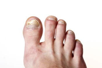 Toenail fungus treatment in the Toronto, Scarborough, Markham, Richmond Hill, Oshawa, Vaughan, Brampton, Mississauga, Oakville Ontario areas