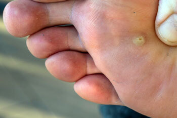 Plantar Warts Treatment in the Toronto, Scarborough, Markham, Richmond Hill, Oshawa, Vaughan, Brampton, Mississauga, Oakville Ontario areas