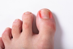 Treatment Options for Ingrown Toenails