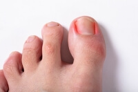 Treatment Options for Ingrown Toenails
