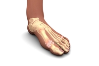 Risk Factors for Gout