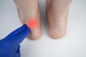 Managing Achilles Tendon Bursitis
