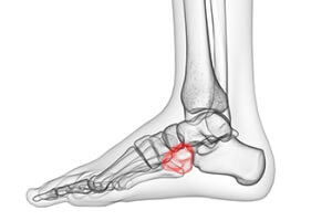 Causes and Symptoms of Cuboid Syndrome