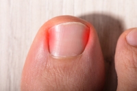 When Your Toenail Turns Painful