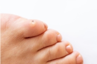 Symptoms and Causes of Corns