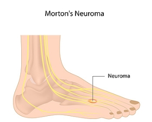 Morton’s Neuroma and Forefoot Pain