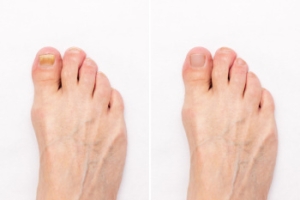 Possible Causes of Toenail Loss