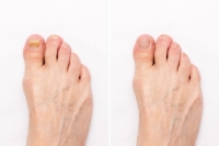 Possible Causes of Toenail Loss