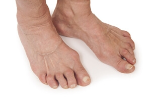 Joint Pain in the Feet and Rheumatoid Arthritis