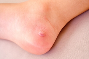 Managing an Infected Foot Blister