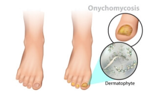 Causes and Risk Factors of Toenail Fungus