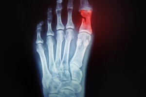Types of Broken Toe Injuries